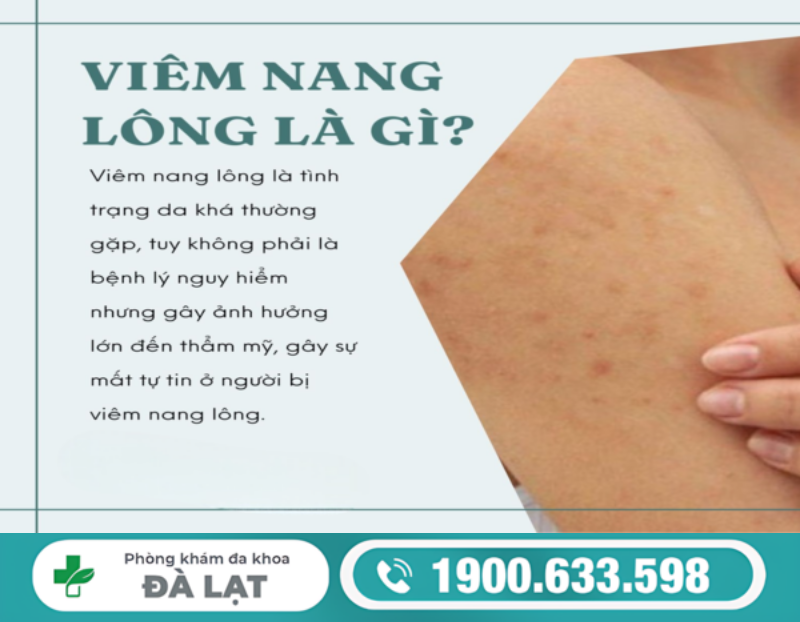 Hình ảnh minh họa