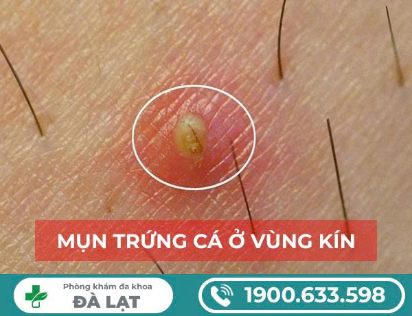 Hình ảnh minh họa