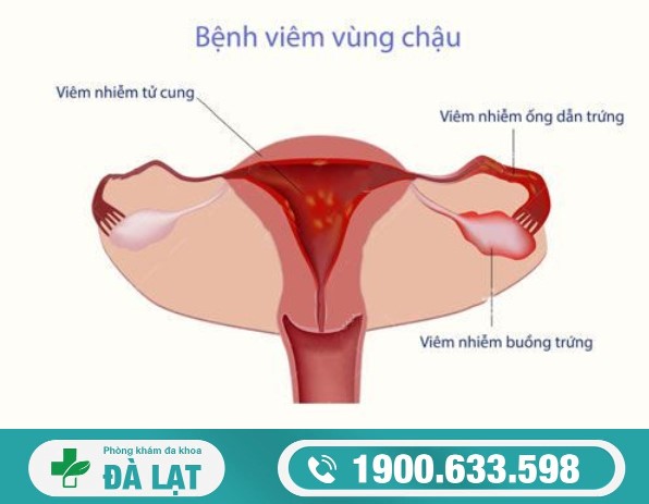 Hình ảnh minh họa